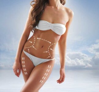 Understanding CoolSculpting Creve Coeur & Chesterfield, MO